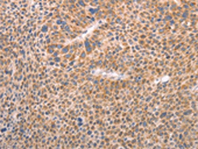 The image on the left is immunohistochemistry of paraffin-embedded Human liver cancer tissue using the antibody Antibody) at dilution 1/30, on the right is treated with fusion protein. (Original magnification: ×200)