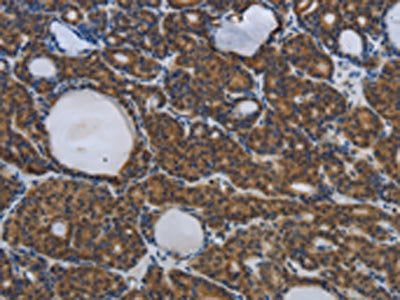 The image on the left is immunohistochemistry of paraffin-embedded Human thyroid cancer tissue using SPAG4 Antibody(SPAG4 Antibody) at dilution 1/25, on the right is treated with synthetic peptide. (Original magnification: ×200)Rabbit anti-Human SPAG4 Polyclonal Antibody