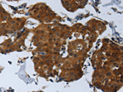 The image on the left is immunohistochemistry of paraffin-embedded Human breast cancer tissue using the antibody Antibody) at dilution 1/25, on the right is treated with synthetic peptide. (Original magnification: ×200)Rabbit anti-Human SPAG4 Polyclonal Antibody