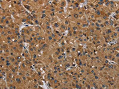 The image on the left is immunohistochemistry of paraffin-embedded Human liver cancer tissue using HSD3B7 Antibody(HSD3B7 Antibody) at dilution 1/40, on the right is treated with fusion protein. (Original magnification: ×200)Rabbit anti-Human HSD3B7 Polyclonal Antibody