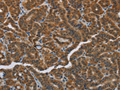 The image on the left is immunohistochemistry of paraffin-embedded Human thyroid cancer tissue using the antibody Antibody) at dilution 1/40, on the right is treated with fusion protein. (Original magnification: ×200)Rabbit anti-Human HSD3B7 Polyclonal Antibody
