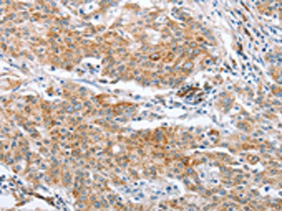 The image on the left is immunohistochemistry of paraffin-embedded Human gastric cancer tissue using CRELD2 Antibody(CRELD2 Antibody) at dilution 1/50, on the right is treated with fusion protein. (Original magnification: ×200)Rabbit anti-Human CRELD2 Polyclonal Antibody