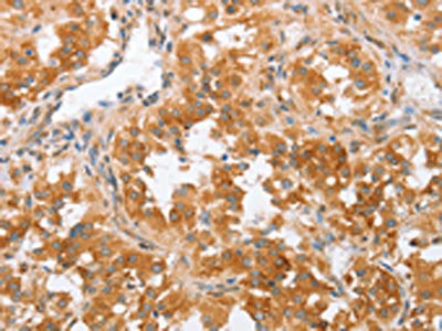 The image on the left is immunohistochemistry of paraffin-embedded Human thyroid cancer tissue using the antibody Antibody) at dilution 1/50, on the right is treated with fusion protein. (Original magnification: ×200)Rabbit anti-Human CRELD2 Polyclonal Antibody