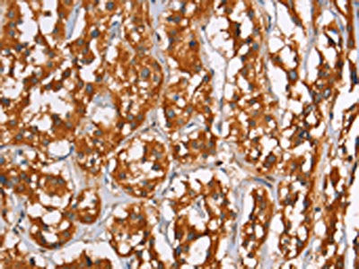 The image on the left is immunohistochemistry of paraffin-embedded Human thyroid cancer tissue using the antibody Antibody) at dilution 1/40, on the right is treated with synthetic peptide. (Original magnification: ×200)Rabbit anti-Human PLIN2 Polyclonal Antibody