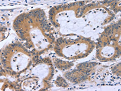 The image on the left is immunohistochemistry of paraffin-embedded Human colon cancer tissue using MAPRE3 Antibody(ECE1 Antibody) at dilution 1/30, on the right is treated with fusion protein. (Original magnification: ×200)