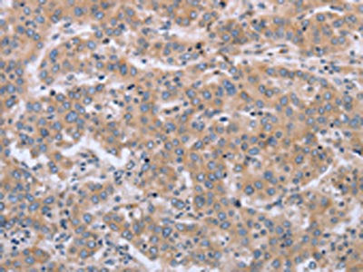 The image on the left is immunohistochemistry of paraffin-embedded Human liver cancer tissue using the antibody Antibody) at dilution 1/30, on the right is treated with fusion protein. (Original magnification: ×200)