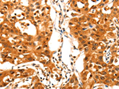 The image on the left is immunohistochemistry of paraffin-embedded Human lung cancer tissue using SERPINB5 Antibody(SERPINB5 Antibody) at dilution 1/60, on the right is treated with fusion protein. (Original magnification: ×200)Rabbit anti-Human SERPINB5 Polyclonal Antibody
