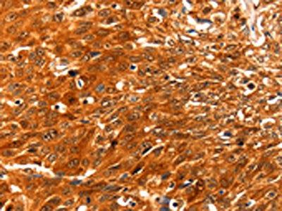 The image on the left is immunohistochemistry of paraffin-embedded Human esophagus cancer tissue using the antibody Antibody) at dilution 1/60, on the right is treated with fusion protein. (Original magnification: ×200)Rabbit anti-Human SERPINB5 Polyclonal Antibody