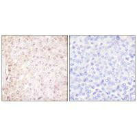 Immunohistochemical analysis of paraffin-embedded human breast carcinoma tissue using Stefin B antibody.Rabbit anti-Human CSTB Polyclonal Antibody
