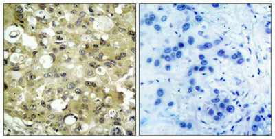 Immunohistochemical analysis of paraffin-embedded human breast carcinoma tissue using VEGFR2(Ab-951) Antibody(left) or the same antibody preincubated with blocking peptide(right).