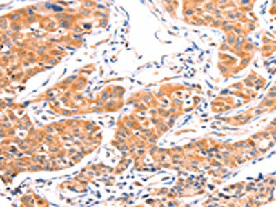 The image on the left is immunohistochemistry of paraffin-embedded Human lung cancer tissue using AMPD1 Antibody(AMPD1 Antibody) at dilution 1/80, on the right is treated with synthetic peptide. (Original magnification: ×200)Rabbit anti-Human AMPD1 Polyclonal Antibody