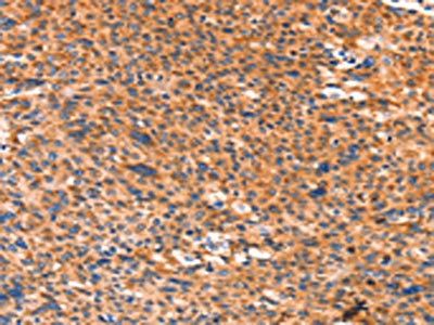 The image on the left is immunohistochemistry of paraffin-embedded Human liver cancer tissue using the antibody Antibody) at dilution 1/80, on the right is treated with synthetic peptide. (Original magnification: ×200)Rabbit anti-Human AMPD1 Polyclonal Antibody