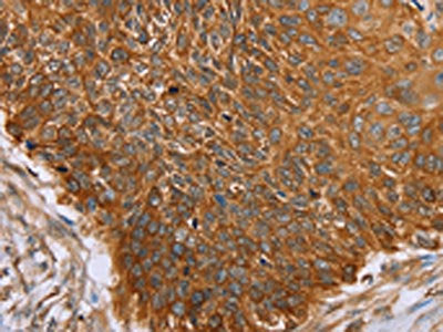 The image on the left is immunohistochemistry of paraffin-embedded Human esophagus cancer tissue using PAICS Antibody(PAICS Antibody) at dilution 1/50, on the right is treated with fusion protein. (Original magnification: ×200)Rabbit anti-Human PAICS Polyclonal Antibody