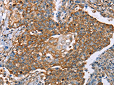 The image on the left is immunohistochemistry of paraffin-embedded Human cervical cancer tissue using the antibody Antibody) at dilution 1/50, on the right is treated with fusion protein. (Original magnification: ×200)Rabbit anti-Human PAICS Polyclonal Antibody