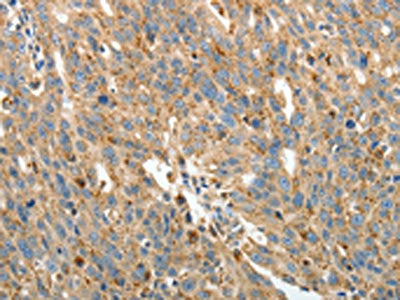 The image on the left is immunohistochemistry of paraffin-embedded Human ovarian cancer tissue using PRCP Antibody(PRCP Antibody) at dilution 1/15, on the right is treated with fusion protein. (Original magnification: ×200)Rabbit anti-Human PRCP Polyclonal Antibody