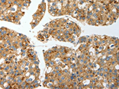 The image on the left is immunohistochemistry of paraffin-embedded Human liver cancer tissue using the antibody Antibody) at dilution 1/15, on the right is treated with fusion protein. (Original magnification: ×200)Rabbit anti-Human PRCP Polyclonal Antibody