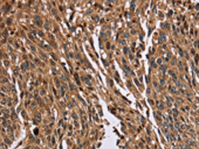 The image on the left is immunohistochemistry of paraffin-embedded Human lung cancer tissue using HMGN5 Antibody(HMGN5 Antibody) at dilution 1/20, on the right is treated with fusion protein. (Original magnification: ×200)Rabbit anti-Human HMGN5 Polyclonal Antibody