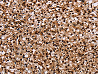 The image on the left is immunohistochemistry of paraffin-embedded Human prostate cancer tissue using the antibody Antibody) at dilution 1/20, on the right is treated with fusion protein. (Original magnification: ×200)Rabbit anti-Human HMGN5 Polyclonal Antibody