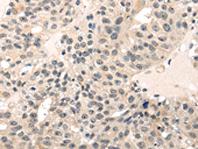 The image on the left is immunohistochemistry of paraffin-embedded Human breast cancer tissue using MED28 Antibody(MED28 Antibody) at dilution 1/30, on the right is treated with fusion protein. (Original magnification: ×200)