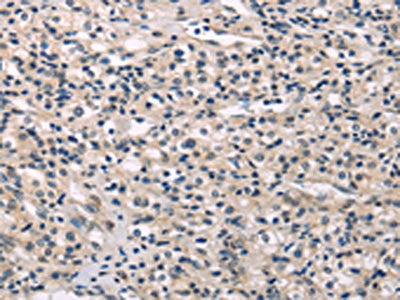The image on the left is immunohistochemistry of paraffin-embedded Human prostate cancer tissue using the antibody Antibody) at dilution 1/30, on the right is treated with fusion protein. (Original magnification: ×200)