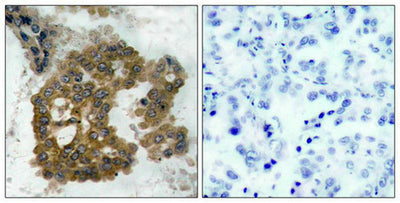 Immunohistochemical analysis of paraffin-embedded human lung carcinoma tissue using Akt2(Phospho-Ser474) Antibody(left) or the same antibody preincubated with blocking peptide(right).Rabbit anti-Human AKT2 Polyclonal Antibody