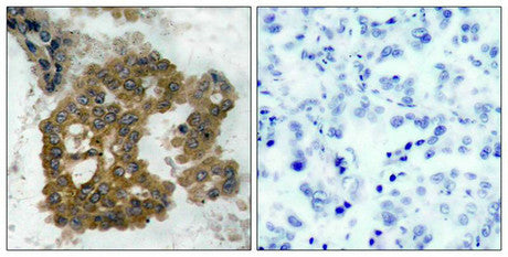 Immunohistochemical analysis of paraffin-embedded human lung carcinoma tissue using Akt2(Phospho-Ser474) Antibody(left) or the same antibody preincubated with blocking peptide(right).Rabbit anti-Human AKT2 Polyclonal Antibody