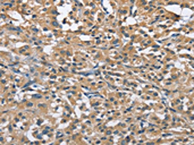 The image on the left is immunohistochemistry of paraffin-embedded Human thyroid cancer tissue using the antibody Antibody) at dilution 1/30, on the right is treated with fusion protein. (Original magnification: ×200)Rabbit anti-Human FLT3 Polyclonal Antibody
