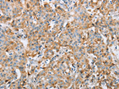 The image on the left is immunohistochemistry of paraffin-embedded Human gastric cancer tissue using FOXF2 Antibody(FOXF2 Antibody) at dilution 1/30, on the right is treated with synthetic peptide. (Original magnification: ×200)Rabbit anti-Human FOXF2 Polyclonal Antibody