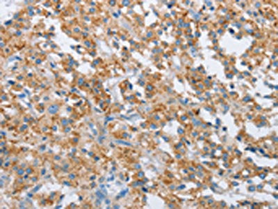 The image on the left is immunohistochemistry of paraffin-embedded Human thyroid cancer tissue using the antibody Antibody) at dilution 1/30, on the right is treated with synthetic peptide. (Original magnification: ×200)Rabbit anti-Human FOXF2 Polyclonal Antibody