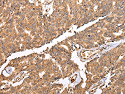 The image on the left is immunohistochemistry of paraffin-embedded Human prostate cancer tissue using the antibody Antibody) at dilution 1/25, on the right is treated with fusion protein. (Original magnification: ×200)Rabbit anti-Human UQCRC2 Polyclonal Antibody