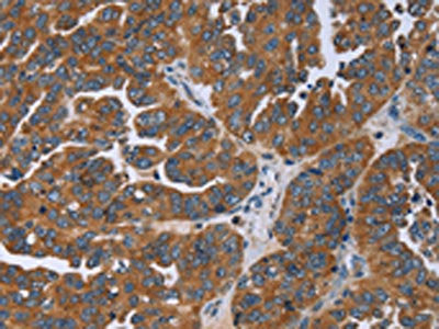 The image on the left is immunohistochemistry of paraffin-embedded Human ovarian cancer tissue using the antibody Antibody) at dilution 1/50, on the right is treated with fusion protein. (Original magnification: ×200)Rabbit anti-Human GAB2 Polyclonal Antibody