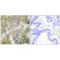 Immunohistochemistry analysis of paraffin-embedded human colon carcinoma tissue, using ES8L3 antibody.Rabbit anti-Human EPS8L3 Polyclonal Antibody