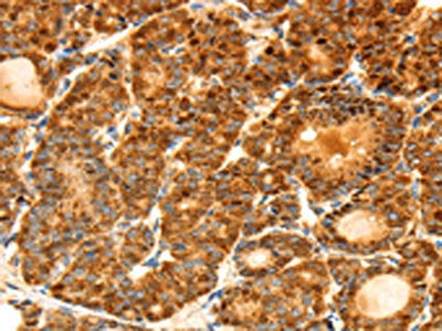 The image on the left is immunohistochemistry of paraffin-embedded Human thyroid cancer tissue using FSHR Antibody(FSHR Antibody) at dilution 1/70, on the right is treated with fusion protein. (Original magnification: ×200)Rabbit anti-Human FSHR Polyclonal Antibody