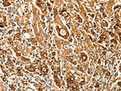 The image on the left is immunohistochemistry of paraffin-embedded Human gastic cancer tissue using the antibody Antibody) at dilution 1/70, on the right is treated with fusion protein. (Original magnification: ×200)Rabbit anti-Human FSHR Polyclonal Antibody