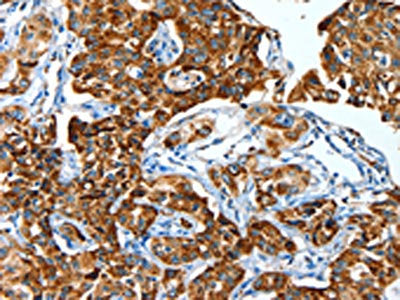 The image on the left is immunohistochemistry of paraffin-embedded Human lung cancer tissue using ALDH6A1 Antibody(ALDH6A1 Antibody) at dilution 1/45, on the right is treated with fusion protein. (Original magnification: ×200)Rabbit anti-Human ALDH6A1 Polyclonal Antibody