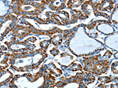 The image on the left is immunohistochemistry of paraffin-embedded Human thyroid cancer tissue using the antibody Antibody) at dilution 1/45, on the right is treated with fusion protein. (Original magnification: ×200)Rabbit anti-Human ALDH6A1 Polyclonal Antibody