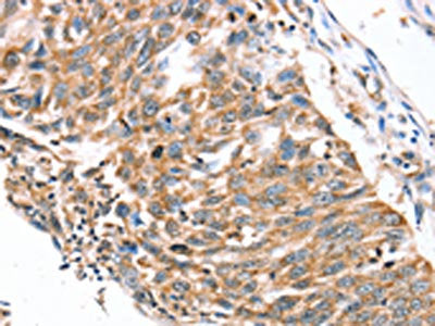 The image on the left is immunohistochemistry of paraffin-embedded Human lung cancer tissue using SDC3 Antibody(SDC3 Antibody) at dilution 1/30, on the right is treated with synthetic peptide. (Original magnification: ×200)Rabbit anti-Human SDC3 Polyclonal Antibody
