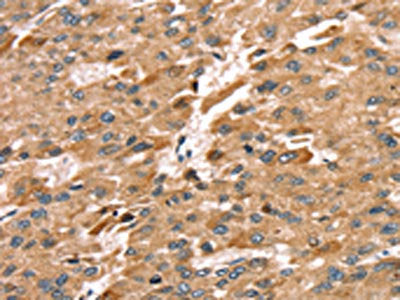 The image on the left is immunohistochemistry of paraffin-embedded Human liver cancer tissue using the antibody Antibody) at dilution 1/30, on the right is treated with synthetic peptide. (Original magnification: ×200)Rabbit anti-Human SDC3 Polyclonal Antibody