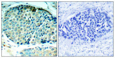 Immunohistochemical analysis of paraffin-embedded human breast carcinoma tissue using HSP27(Phospho-Ser78) Antibody(left) or the same antibody preincubated with blocking peptide(right).Rabbit anti-Human HSPB1 Polyclonal Antibody