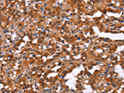 The image on the left is immunohistochemistry of paraffin-embedded Human thyroid cancer tissue using HINT1 Antibody(HINT1 Antibody) at dilution 1/50, on the right is treated with synthetic peptide. (Original magnification: ×200)Rabbit anti-Human HINT1 Polyclonal Antibody