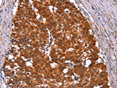 The image on the left is immunohistochemistry of paraffin-embedded Human gastic cancer tissue using the antibody Antibody) at dilution 1/50, on the right is treated with synthetic peptide. (Original magnification: ×200)Rabbit anti-Human HINT1 Polyclonal Antibody