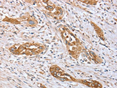 The image on the left is immunohistochemistry of paraffin-embedded Human esophagus cancer tissue using PPP2R3A Antibody(PPP2R3A Antibody) at dilution 1/40, on the right is treated with synthetic peptide. (Original magnification: ×200)Rabbit anti-Human PPP2R3A Polyclonal Antibody
