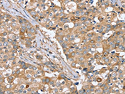 The image on the left is immunohistochemistry of paraffin-embedded Human breast cancer tissue using the antibody Antibody) at dilution 1/40, on the right is treated with synthetic peptide. (Original magnification: ×200)Rabbit anti-Human PPP2R3A Polyclonal Antibody