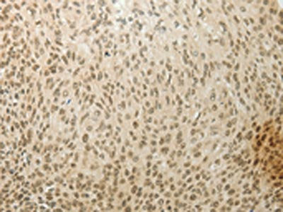 The image on the left is immunohistochemistry of paraffin-embedded Human cervical cancer tissue using MYSM1 Antibody(MYSM1 Antibody) at dilution 1/60, on the right is treated with synthetic peptide. (Original magnification: ×200)Rabbit anti-Human MYSM1 Polyclonal Antibody