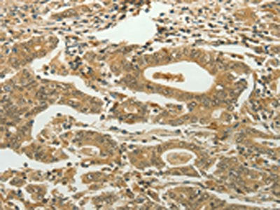 The image on the left is immunohistochemistry of paraffin-embedded Human gastric cancer tissue using the antibody Antibody) at dilution 1/60, on the right is treated with synthetic peptide. (Original magnification: ×200)Rabbit anti-Human MYSM1 Polyclonal Antibody
