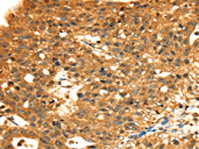 The image on the left is immunohistochemistry of paraffin-embedded Human breast cancer tissue using STX8 Antibody(STX8 Antibody) at dilution 1/45, on the right is treated with fusion protein. (Original magnification: ×200)Rabbit anti-Human STX8 Polyclonal Antibody