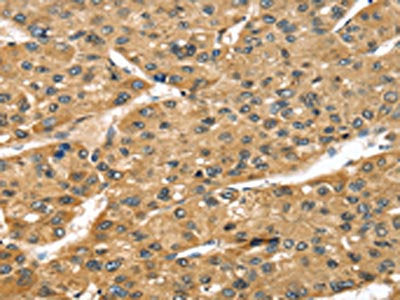 The image on the left is immunohistochemistry of paraffin-embedded Human liver cancer tissue using the antibody Antibody) at dilution 1/45, on the right is treated with fusion protein. (Original magnification: ×200)Rabbit anti-Human STX8 Polyclonal Antibody