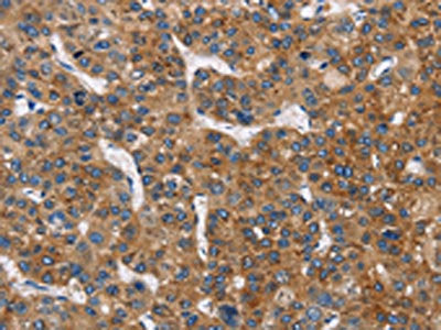 The image on the left is immunohistochemistry of paraffin-embedded Human liver cancer tissue using BLK Antibody(BLK Antibody) at dilution 1/20, on the right is treated with fusion protein. (Original magnification: ×200)