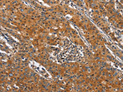 The image on the left is immunohistochemistry of paraffin-embedded Human gastic cancer tissue using the antibody Antibody) at dilution 1/20, on the right is treated with fusion protein. (Original magnification: ×200)