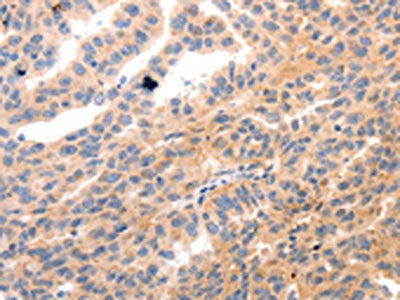 The image on the left is immunohistochemistry of paraffin-embedded Human ovarian cancer tissue using MYL9 Antibody(MYL9 Antibody) at dilution 1/80, on the right is treated with synthetic peptide. (Original magnification: ×200)Rabbit anti-Human MYL9 Polyclonal Antibody